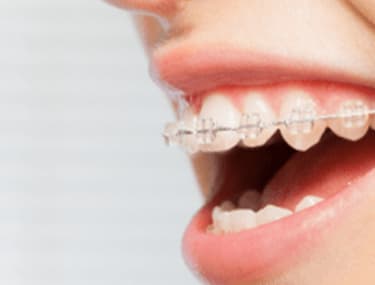 小臼歯を抜歯しない矯正